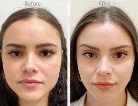 Face Lift - Adhésifs lifting invisible naturel